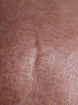 cicatrice.jpg (363.71 Kio) Vu 4858 fois cicatrice.jpg